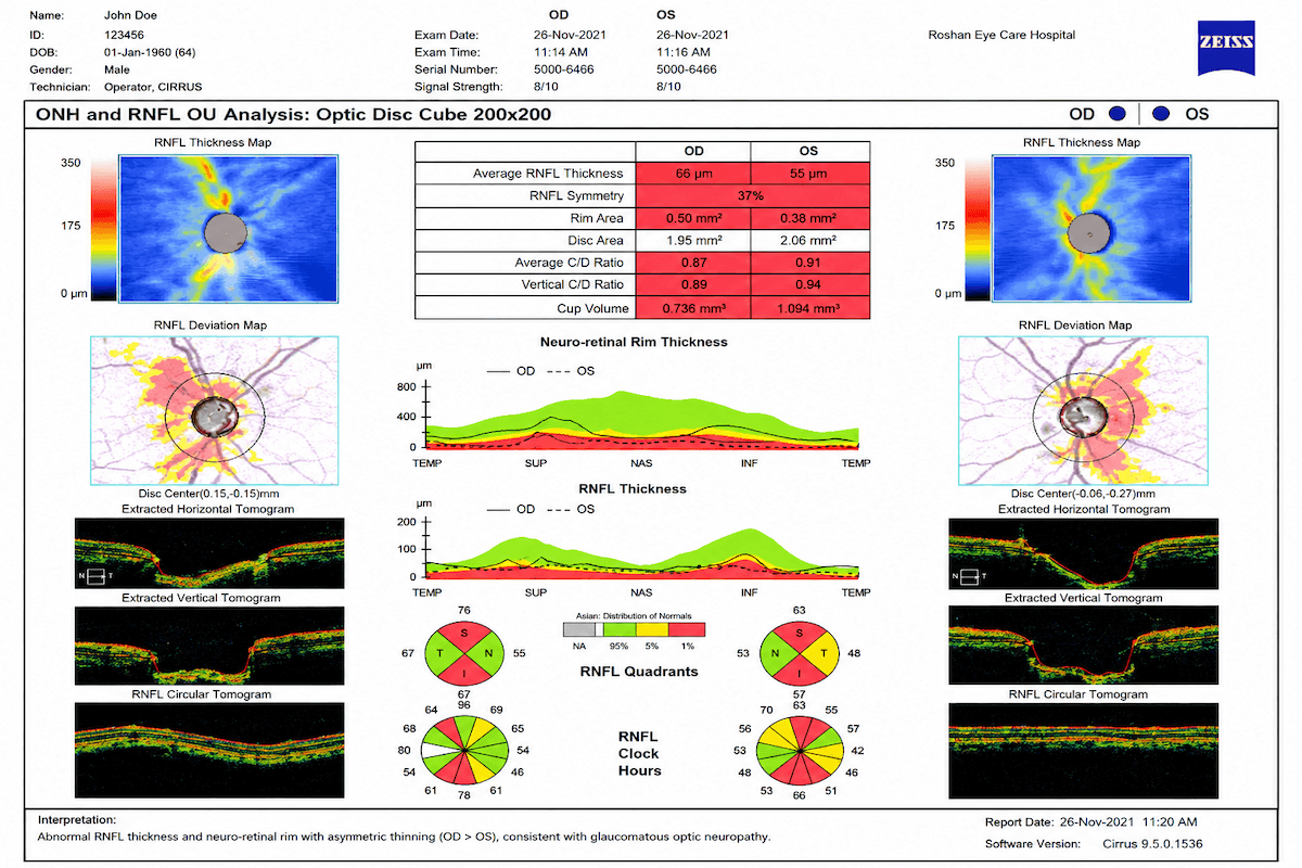 Glaucoma work-up. Visual field or optic nerve photography