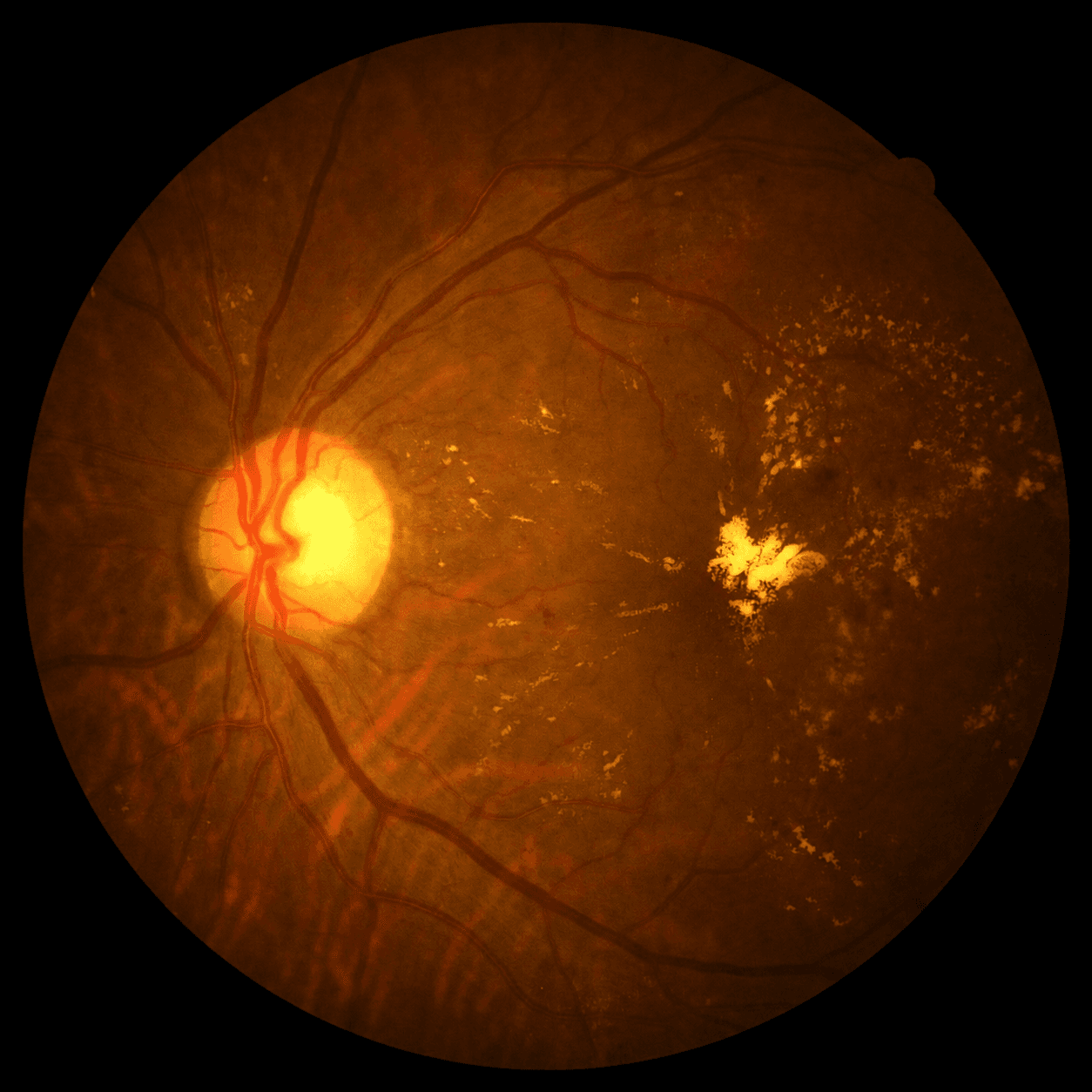 Retinal care. Fundus imaging for diabetic retinopathy